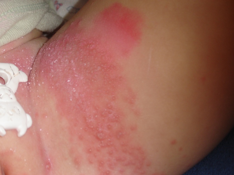 What is Candidiasis? - webmd.com